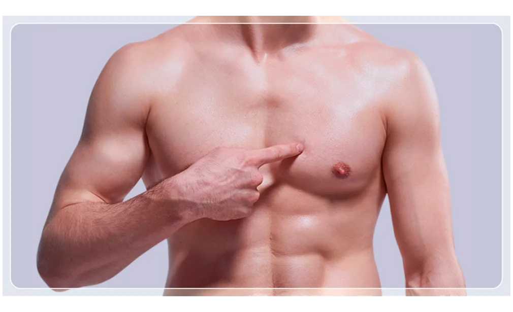 Ginecomastia
